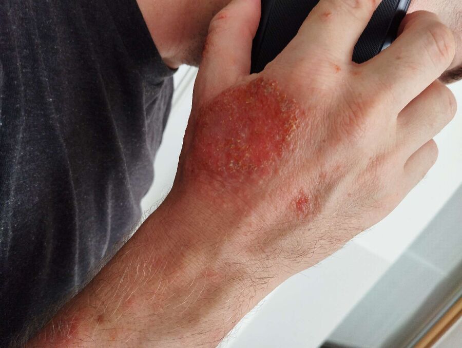 Bettwanzen_bekaempfen